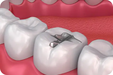 Fillings and Restoration