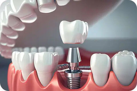 Dental Implants