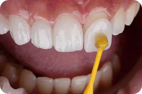 Porcelain Veneers