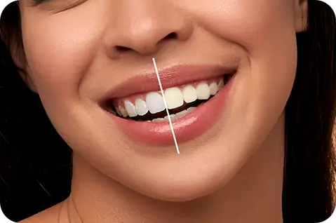 Teeth Whitening
